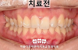 수술전