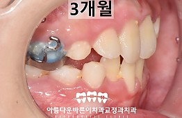 수술후