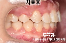 수술후