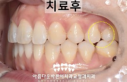 수술후