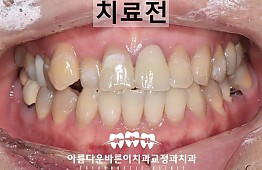 수술전