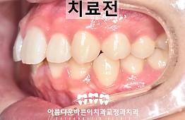 수술전