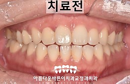 수술전