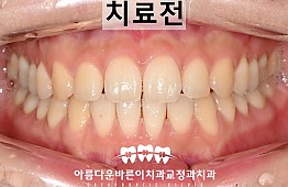수술전