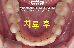 수술후