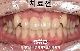 수술전