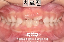 수술전