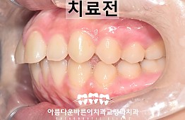 수술전