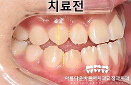 수술전