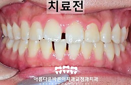 수술전