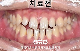 수술전