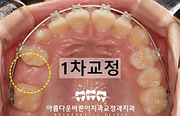 수술후