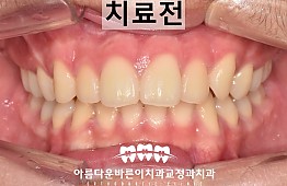 수술전