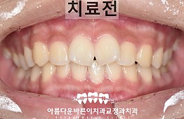 수술전