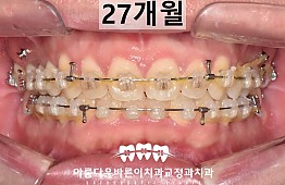 수술후