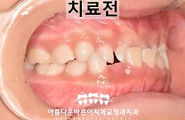 수술전
