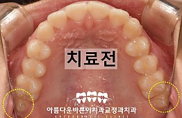 수술전