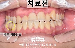 수술전