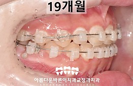 수술후