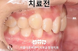 수술전