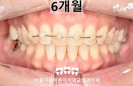 수술후