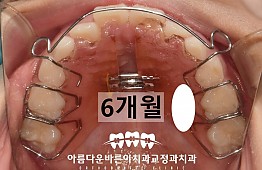 수술후