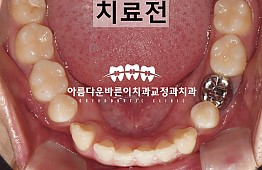 수술전