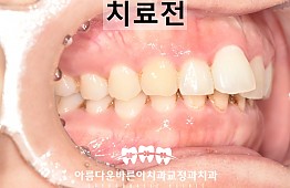 수술전