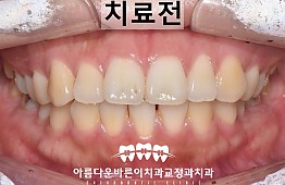 수술전