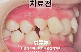 수술전