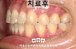 수술후