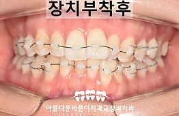 수술후