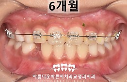 수술후