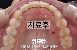 수술후