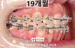 수술후