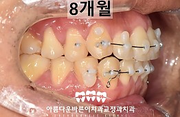 수술후