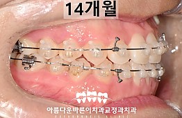 수술후