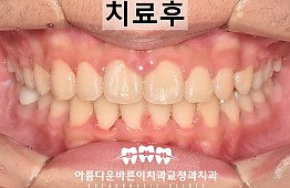 수술후