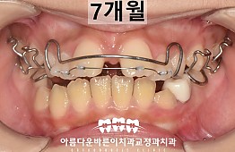 수술후