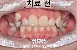 수술전