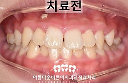 수술전