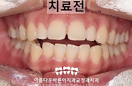 수술전