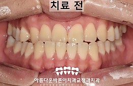 수술전