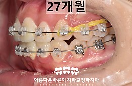 수술후