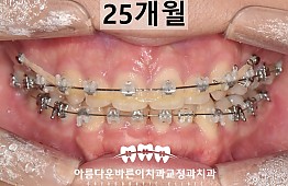 수술후