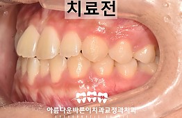 수술전