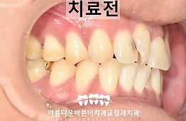 수술전