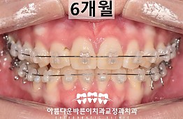 수술후