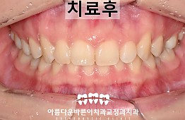 수술후