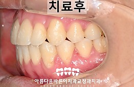 수술후